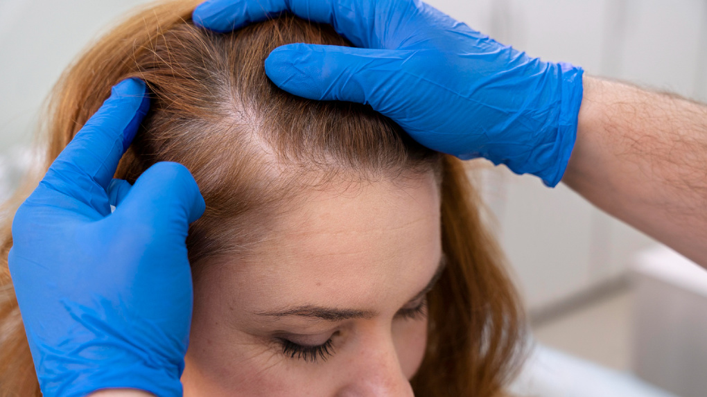 Безоперационная пересадка волос с помощью метода FUE Hand: процесс и особенности метода